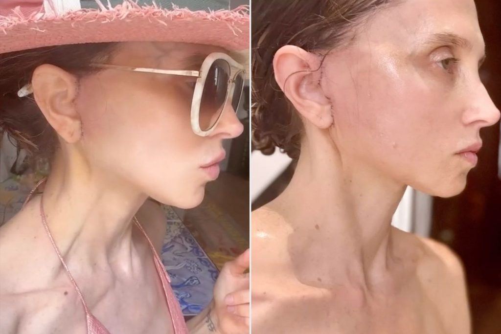Designer Stacey Bendet Shares the Results of Her Neck and Lower Facelift at 46