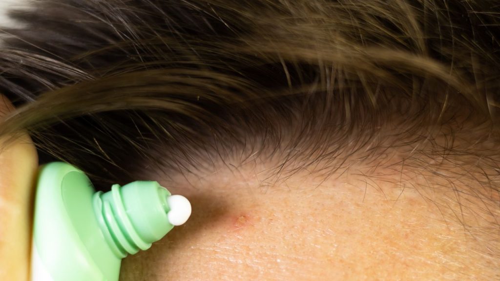 How to Treat Forehead Breakouts, According to a Dermatologist