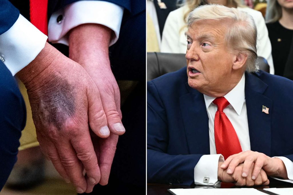 Trump Reveals Bruised Hand Without Makeup amid Online Speculation About His Health