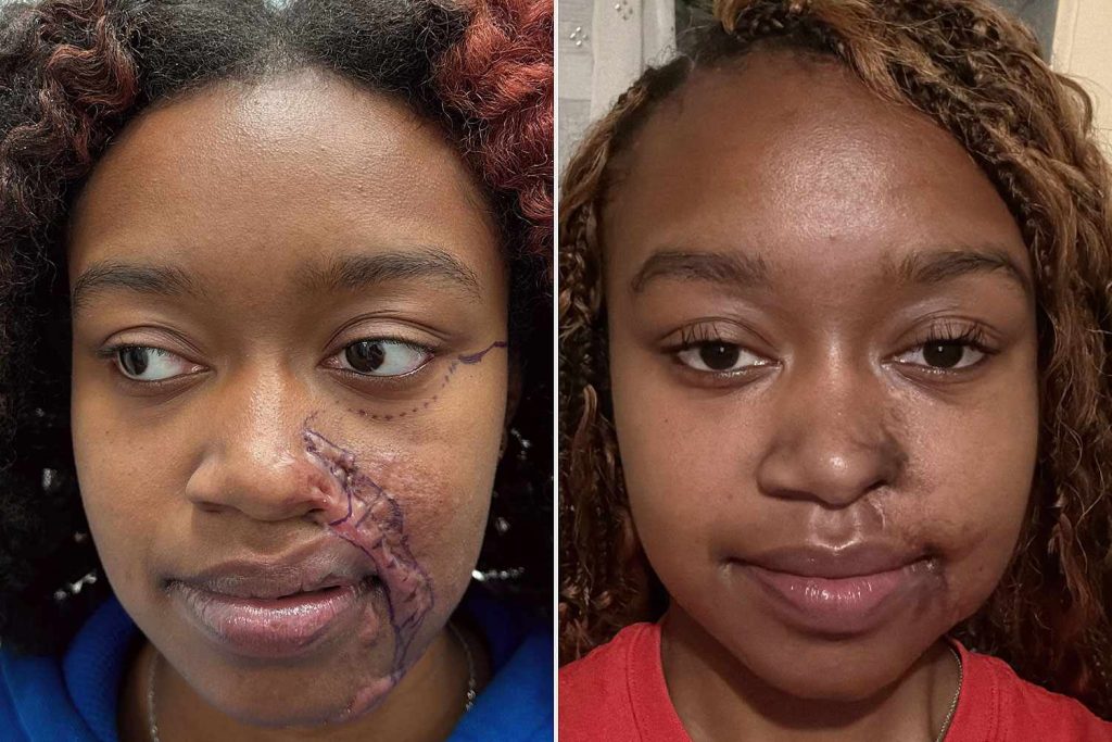 Acid Attack Survivor Gets Reconstructive Surgery. See the Before-and-After Photos (Exclusive)